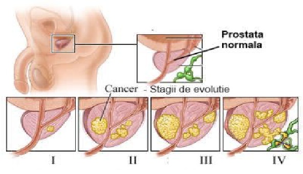 prostatita de stază venoasă modula determina inflamația prostatei